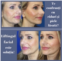 Lifting facial pentru un profil facial tânăr