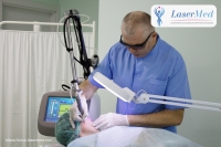 Indepărtarea eliminarea, inlaturarea alunitelor nevilor cu laser in Chisinau, Moldova!